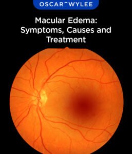 Macular Edema