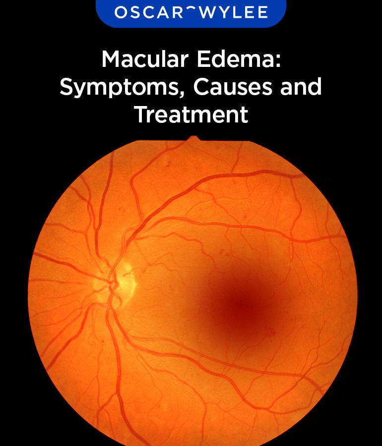 Macular Edema and Retinal Edema: Causes, Symptoms, and Treatments - The Bommer