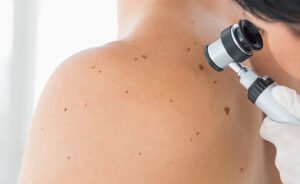 Skin cancer surgery