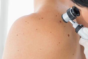 Skin cancer surgery