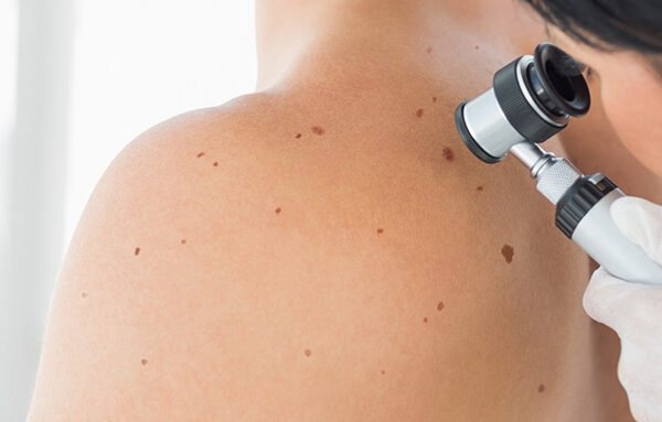 Skin cancer surgery